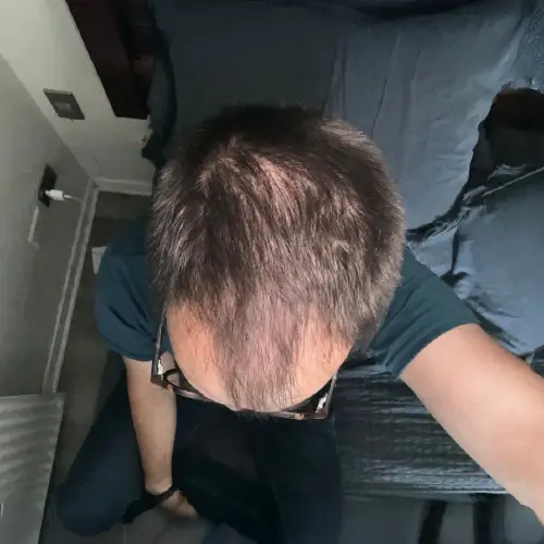 Antes del tratamiento