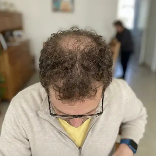 Antes del tratamiento