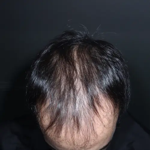 Antes del tratamiento