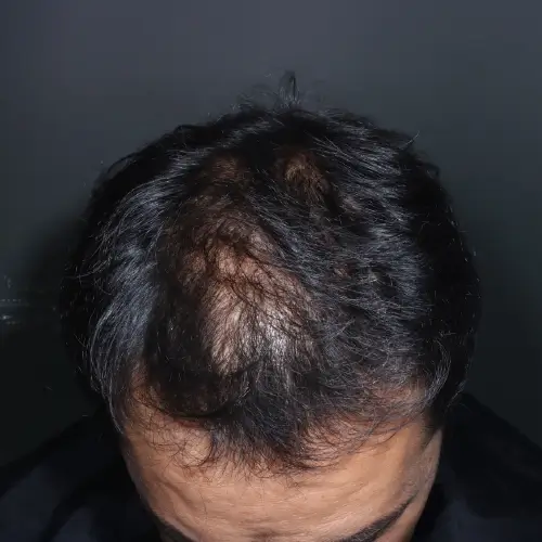 Después del tratamiento