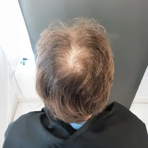 Antes del tratamiento