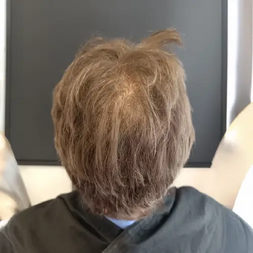 Después del tratamiento