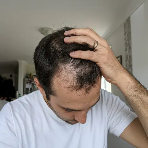 Después del tratamiento