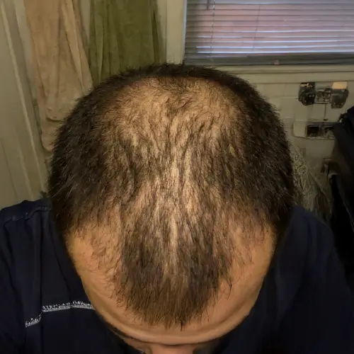 Antes del tratamiento