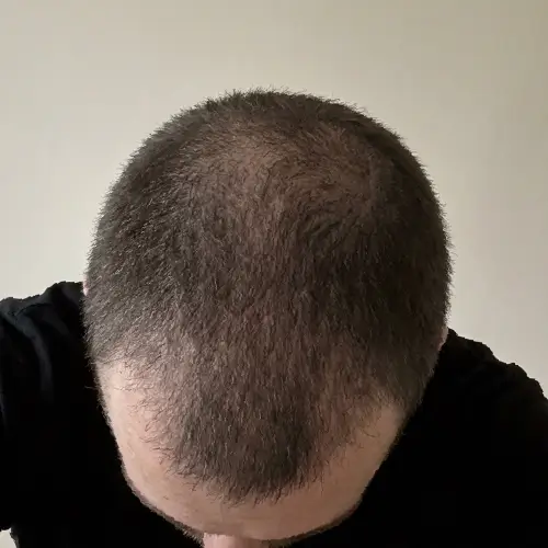 Después del tratamiento