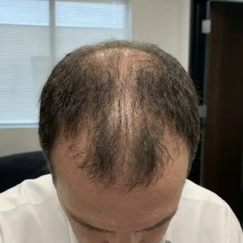 Antes del tratamiento