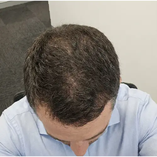 Después del tratamiento