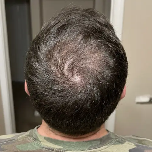 Después del tratamiento