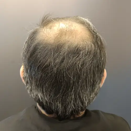 Antes del tratamiento