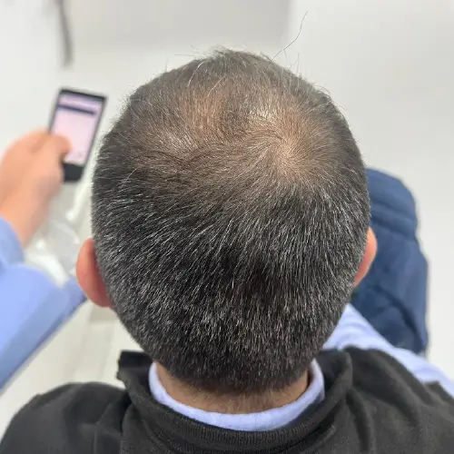 Después del tratamiento